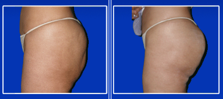 Buttock Augmentation Surgery India, Cost Buttock Augmentation Surgery, Butt Implants, Buttock Augmentation Surgery Cost, Buttock Augmentation Surgery Photos India