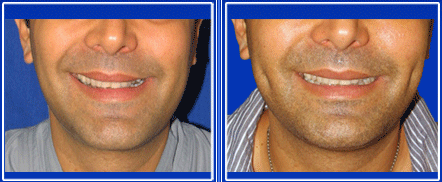 Dimple Creation Surgery India, Cost Dimple Creation Surgery Bangalore, Dimple Creation, Blepharoplasty, Dimple Creation Surgery Cost