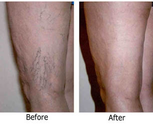 Laser Spider Vein Treatment India,Cost Spider Vein Treatment Mumbai, Laser Spider Vein Treatment Cost, Conventional Surgery For Varicose Veins