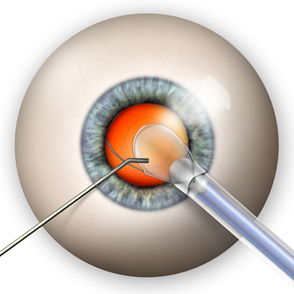 IOL Intraocular Lens Implant Treatment India, Price IOL Implant India, Intraocular Lens, Intraocular Lenses, IOL, Surgery, Optical Express, Icl, Crystalens, Implantable Collamer Lenses, Effective, Laser, Cataract Surgery