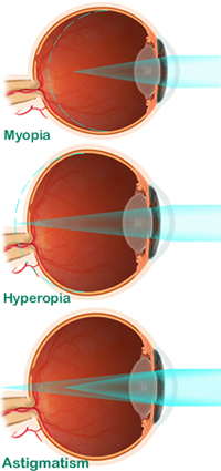 Myopia Surgery India,Cost Myopia Surgery Delhi India,Myopia Eye Surgery, Cost Myopia Surgery, Myopia, Nearsightedness, Laser Vision Treatment, High Myopia Treatment, High Myopia Surgery India