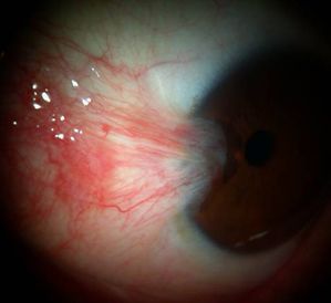 Pterygium Removal Surgery India, Cost Pterygium Removal Surgery India, Cost Pterygium, Pterygium Removal, Pterygium Removal Surgery India, Cost Pterygium Removal Surgery, Pterygium Removal India