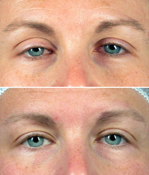 Ptosis Correction Surgery India, Price Ptosis Correction Surgery Delhi, Blepharoplasty, Ptosis Surgery, Blepharoptosis, Low Upper Eyelid, Congenital Ptosis, Acquired Ptosis, Aponeurotic Ptosis, Myogenic Ptosis, Neurogenic Ptosis, Mechanical Ptosis