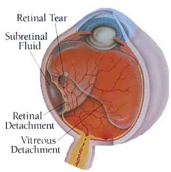 Retinal Detachment Surgery India, Price Retinal Detachment Mumbai India, Laser Eye Surgery, Laser Vision Treatment, Retinal Detachment Surgery India, Cost Retinal Detachment