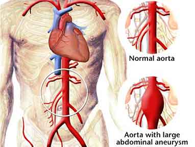 Aortic Aneurysm Surgery in India, Price Aortic Aneurysm Surgery Mumbai, Cost Aortic Aneurysm, Aortic Aneurysm Surgery Delhi India, Best Aortic Aneurysm Surgery Hospital India, India Aortic Aneurysm Surgery Hospital India