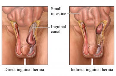 Open Surgical Repair Hernia Surgery india, Cost Hernia Repair Surgery, Open Surgical Repair Hernia Surgery Delhi India, Open Surgical Repair Hernia Surgery Bangalore India