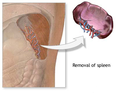 Spleen Removal Splenectomy Surgery India, Cost Spleen Removal Hyderabad, Spleen Removal Splenectomy Surgery Delhi India