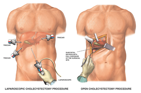 Laparoscopic Cholecystectomy Surgery India, Cost Cholecystectomy Mumbai, 
