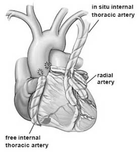 Coronary Artery Bypass Graft Surgery India, Cost Heart Cabg Delhi India, Cost Cabg Surgrey Delhi India, Cost Coronary Artery Bypass, Coronary Artery Bypass Surgery, Coronary Artery, Bypass Surgery