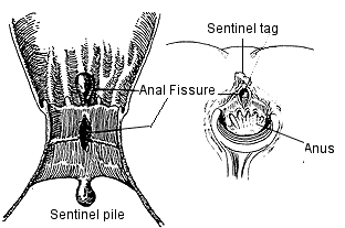 Anal fissure sentinel pile posteriorly