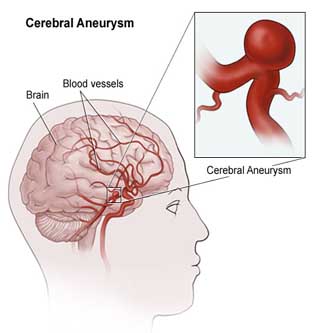 Cerebral Aneurysm Surgery India, Cost Cerebral Aneurysm Surgery Delhi, Cerebral Aneurysm, Brain Aneurysm, Aneurysms, Cerebral Aneurysm Treatments , Disorder, Cerabal Aneurysm
