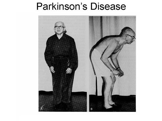 Parkinsons Disease Surgery India, Parkinson's Parkinsons Disease Treatment, Parkinson's Treatment India, Stem Cell Parkinson's, Manipal Parkinson's Stem Cell, Parkinsons Disease Surgery Cost India