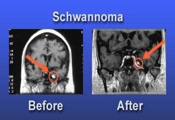 Schwannomas Surgery India, Cost Schwannoma Surgery Hyderabad India, Cost Schwannoma Surgery, Vestibular Schwannoma Surgery, Schwannoma Surgery Risks