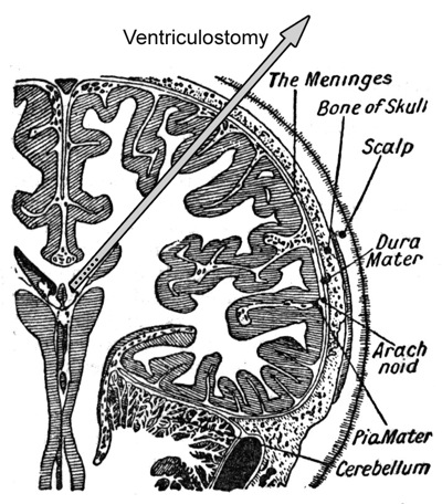 ventriculostomy