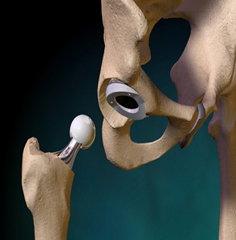 Cost Hip Replacement Surgery Chennai India, Hip Replacement India, Hip Replacement Cost, Hip Replacement Surgery Abroad, Hip Replacement India