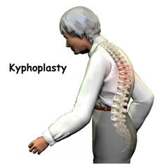 Kyphoplasty Surgery India, Kyphoplasty Spine Surgery India, Kyphoplasty Problem, Kyphoplasty Vertebroplasty, Scoliosis