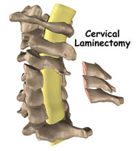 Spinal Laminectomy Surgery, Cost Spinal Laminectomy Surgery Delhi India, Laminectomy Surgery India, Laminectomy Cost, Specialized Laminectomy Spine Hospitals India, Laminectomy, Spines, Backs, Cervical Decompression Lumbar Laminectomy