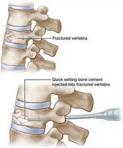 vertebroplasty surgery