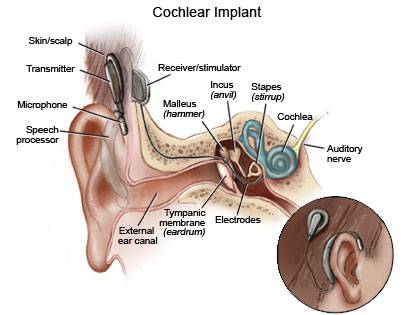 Cochlear Implant Surgery India, Price Cochlear Implant Surgery Delhi India, Cost Cochlear Implant, Cochlear Implant, Cochlear Implant Surgery Delhi India, Cochlear Implant Surgery Bangalore India, Cochlear Implant Surgery Price, Best Cochlear Implant Surgery Hospital India, Hearing Aid Implant, Cochlear Implant Surgery Symptoms, India Laser In Ear Nose And Throat Surgery