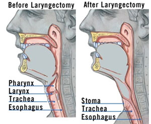 Laryngectomy Surgery India, Price Laryngectomy Surgery Mumbai India, Laryngectomy Surgery Cost, Laryngectomy Surgery Mumbai India, Laryngectomy Surgery In Apollo Hospital, Side Effects Of Laryngectomy Surgery, Laryngectomy Surgery In India, Laryngectomy Surgery Medical Treatments For Patient, Cheap Laryngectomy Medical Treatments In India, Laryngectomy Surgery Yoga & Meditation