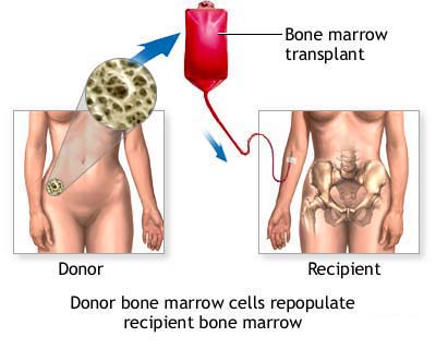 Bone Marrow Transplant India, Cost Bone Marrow Transplant Delhi India, Cost Bone Marrow Transplant, Blood Stem Cells, Bone Marrow Surgery