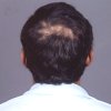 Hair Loss Treatment India, Hair Loss Treatment Cost, Hair Loss Treatment India, Baldness, Hair Loss, Hair Transplant, Hair Transplant Doctor
