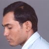 Hair Loss Treatment Cost, Hair Loss Treatment India, Hair Transplantation, Hair Loss, Hair Transplant, Hair Transplant Doctor