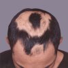 Hair Loss Treatment India, Cost Hair Loss Treatment Bangalore India, Hair Transplantation, Bald, Baldness, Hair Loss