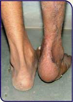 Cost Legs Surgery Mumbai India,Mumbai Legs Surgery Alignment Fix, Bow Leg, Genu Varum Correction, Bow Legs, Leg Disorders, Bandy Legs