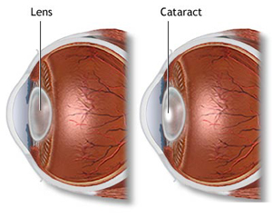 Cataract Surgery India, Price Cataract Surgery Delhi India, Cataracts, Symptoms, Treatment, Cause, Eye, Surgery, Types, Signs, Congenital, Removal, Operations, Prevention, Drugs Cause, Are Cataracts Hereditary, Cataract Cure, Cataract Treatment India, India Ophthalmologists