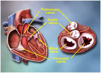 Valve Repair Surgery India, Cost Heart Valve Repair Surgery Delhi India, Heart Valve Replacement Surgery Cost, Center, Heart, Cardiac, Valve Repair Surgery Hospitals India