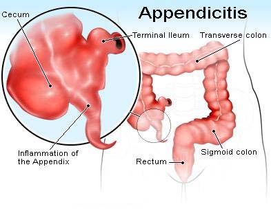 Appendix Surgery India, Price Minimally Invasive Appendix Surgery Delhi, Appendix, Human Appendix, Appendix Anatomy, Vermiform Appendix