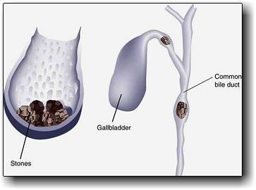 Gallstones Surgery India, Price Gallstones Surgery Bangalore India, Digestive System Diseases, Surgical Techniques, Gallstone