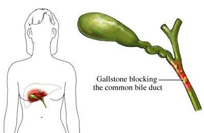 Gallstones Surgery India, Price Gallstones Surgery Bangalore India, Digestive System Diseases india, Surgical Techniques, Gallstone