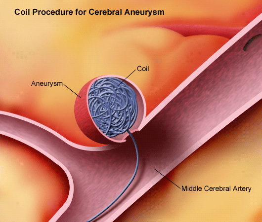 Cerebral Aneurysm Surgery India, Cerebral Aneurysm, Brain Aneurysm, Aneurysms, Intracranial Aneurysm, Cerebral Aneurysm Treatments , Disorder, Cerabal Aneurysm