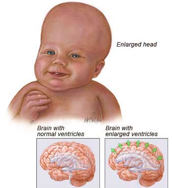 Hydrocephalous Treatment india, Price Hydrocephalous Treatment Delhi, Cost Hydrocephalous, Hydrocephalus, Diseases And Conditions Reference, Health Encyclopedia, Noncommunicating Hydrocephalus