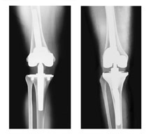 Bilateral Knee Replacement Surgery India, Price Bilateral Knee Surgery, Bilateral Knee Replacement Surgery Cost, Knee Replacement, TKR, Total Knee Replacement Surgery, Total Knee Replacement