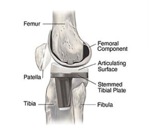 High Flex Knee Replacement Surgery India, Price Flex Knee Replacement, High Flex Knee Replacement India, High Flex Knee Replacement Surgery Cost, Total Knee Replacement, Partial Knee Replacement, Knee Pain, Artificial Knee, Knee Implant