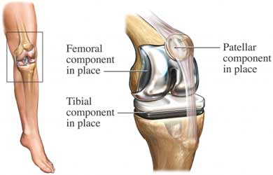 Total Knee Replacement Surgery India, Cost Knee Replacement Delhi India, Total Knee Replacement Surgery India, Arthritis, Arthritis Treatment, Knee Surgery, Total Knee Replacement Surgery Cost