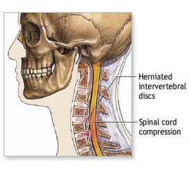 Cervical Spine Surgery Hyderabad India, Cervical Spine Surgery Advantages India, Cervical Spine Surgery, Cervical Spine Surgery Types, Cervical Spine Surgery Option, Cervical Spine Surgery Fusion