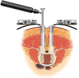 Spinal Endoscopic Surgery india, Cost Spinal Endoscopy Surgery India, Minimally Invasive Endoscopic Spinal Surgery, Arthroscopy, Endoscopic Spinal Surgery, Laparoscopic Spine Surgery