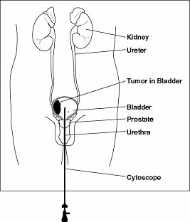 Transurethral Resection Of The Bladder Tumor Surgery India, TURBT-Transurethral Resection Of The Bladder Tumor Surgery Hospital Mumbai India, Transurethral Resection Of The Bladder Tumor Surgery Bangalore India