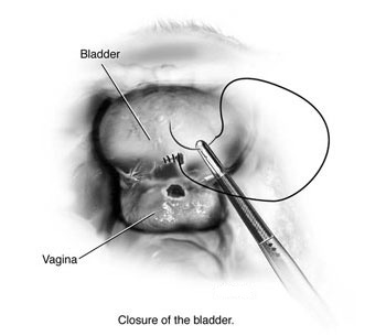 vesicovaginal fistula surgery in india