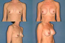 breast-surgery