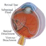cause of torn retina