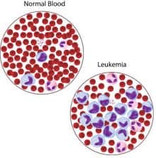 Leukemia Cancer