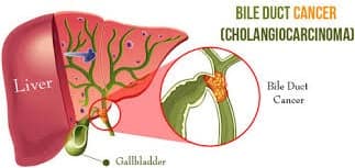 Liver and Bile duct Cancer