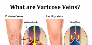 What are varicose veins