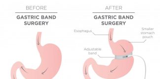 gastric band surgery in india