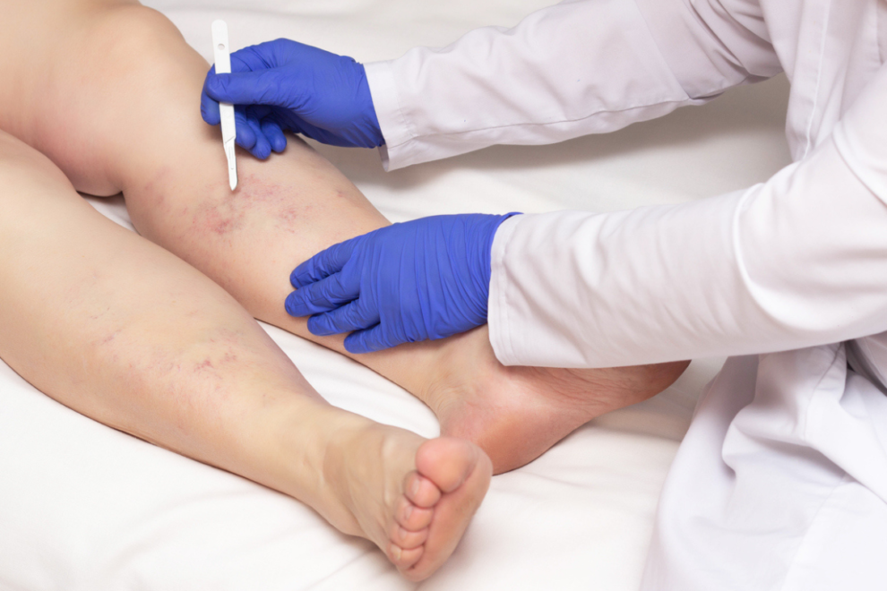 Varicose veins treatment